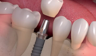 Dental Implants