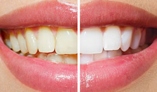 Teeth Whitening